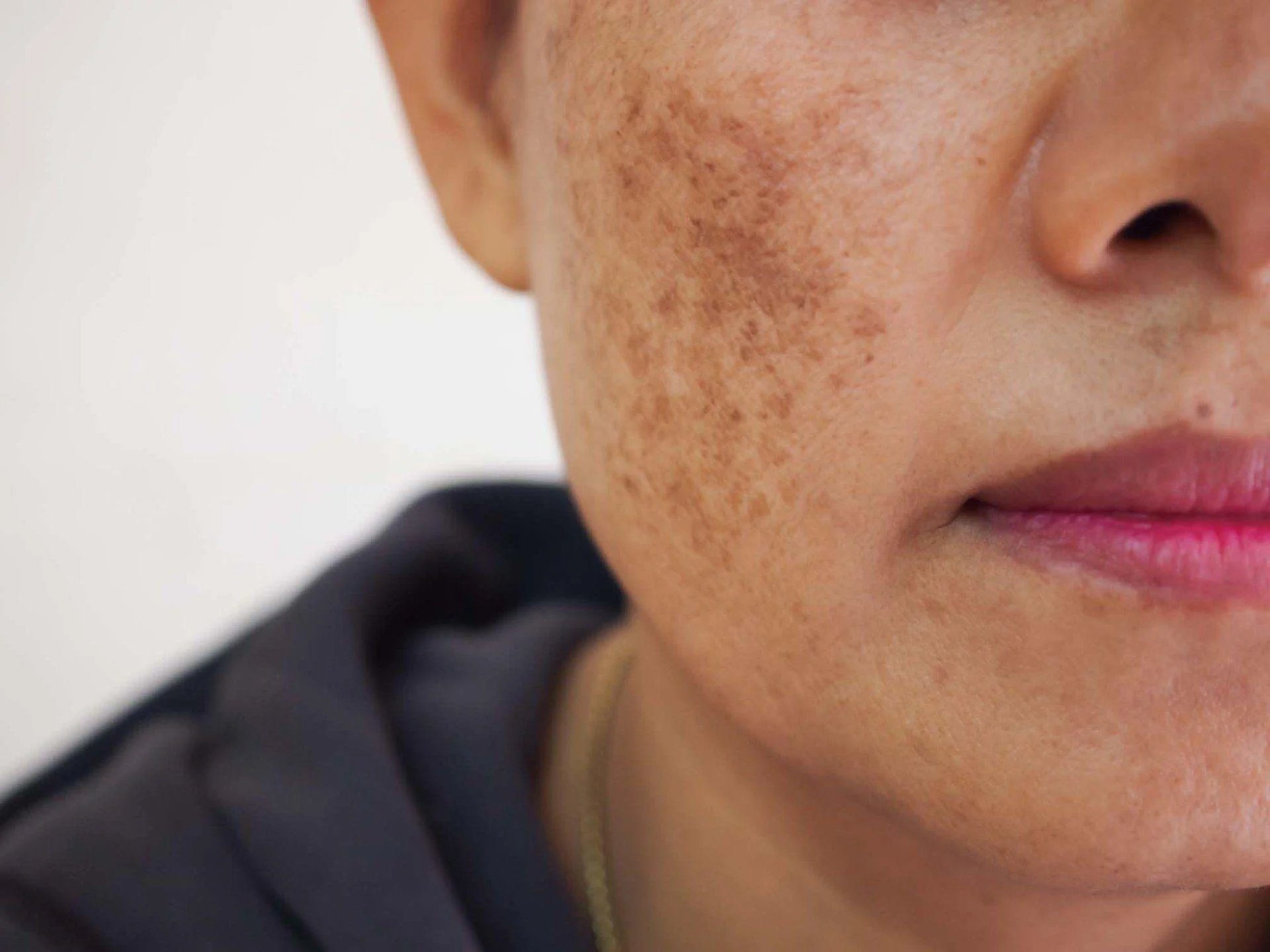 Tratamento para melasma.